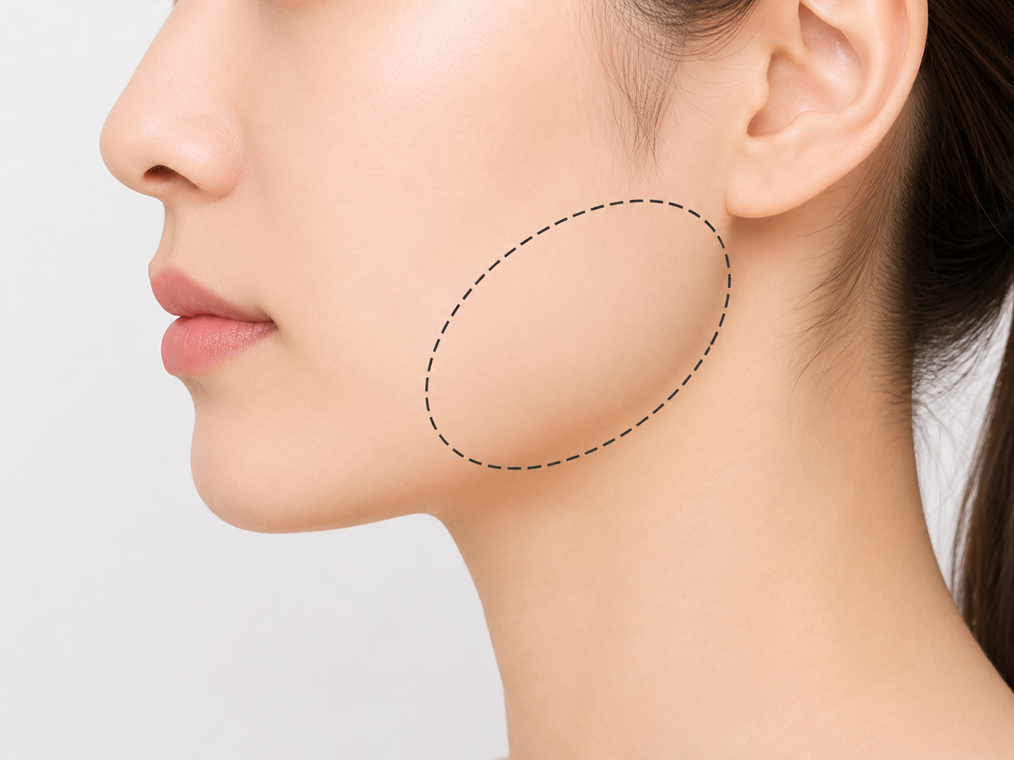 エラボトックス