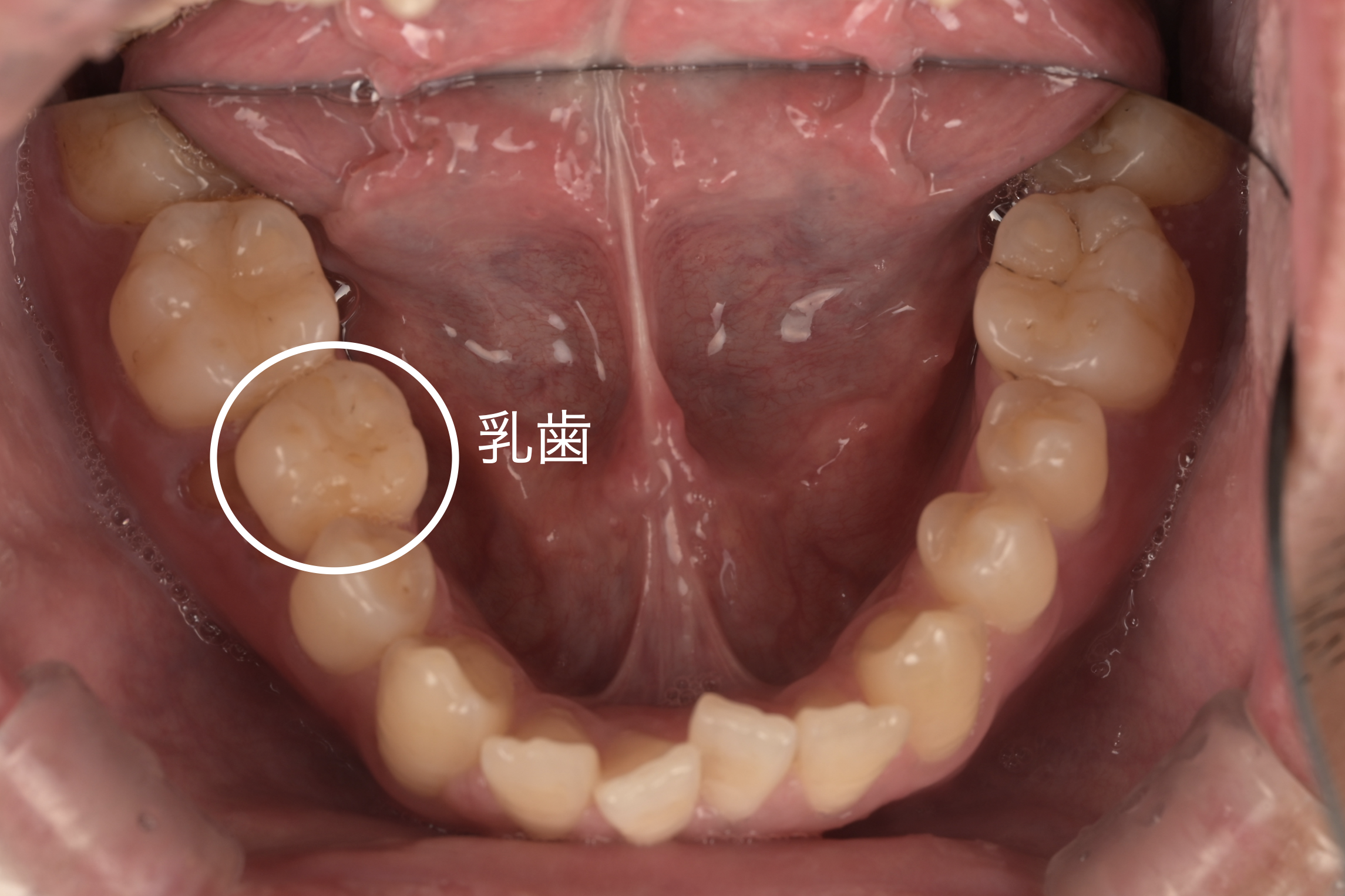 右下に残存している乳歯の口腔内写真