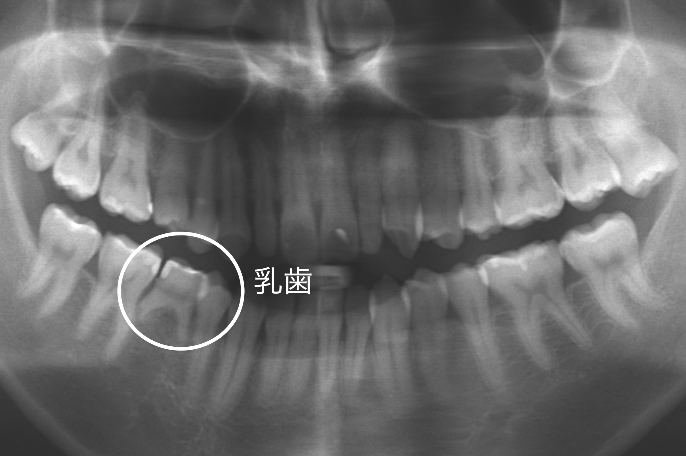 右下5番の永久歯先天性欠損を確認したパノラマレントゲン写真