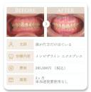 HP_症例_出っ歯2