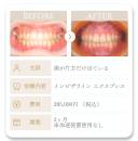 HP_症例_出っ歯1