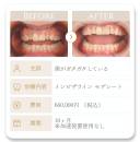 HP_症例_叢生1